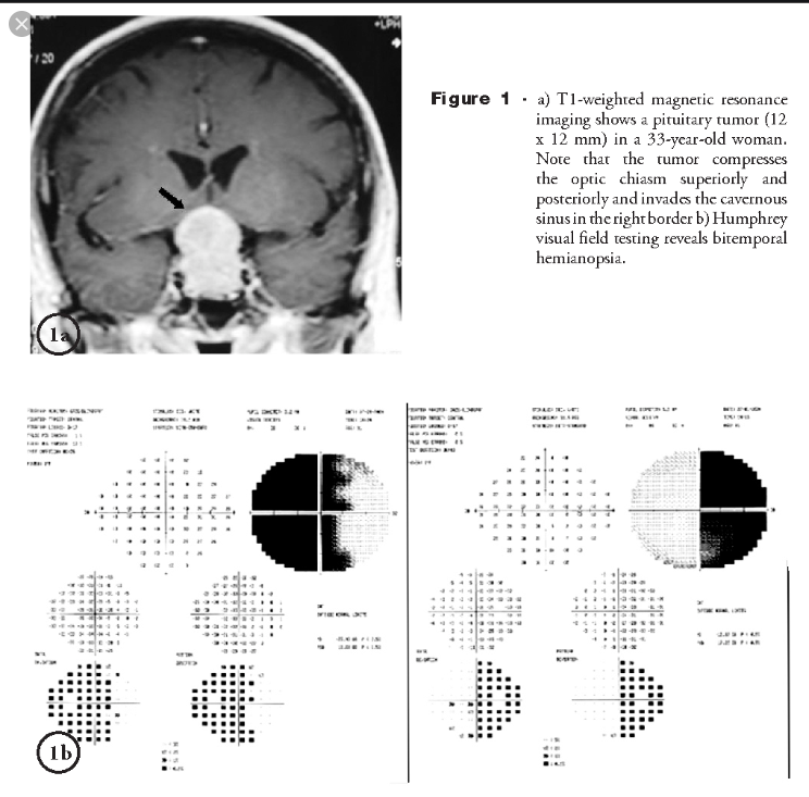 HFA Pituitary Adenoma