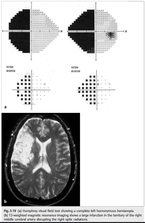 HFA stroke