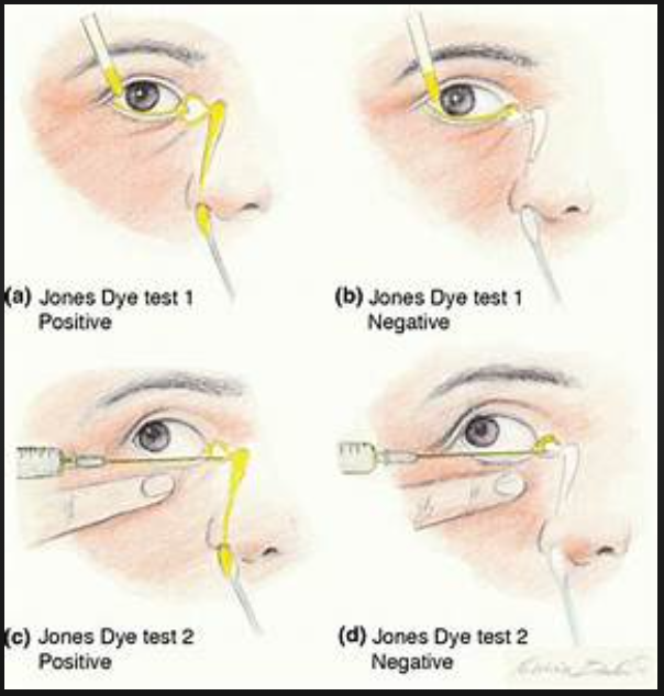 lacrimal drainage 3